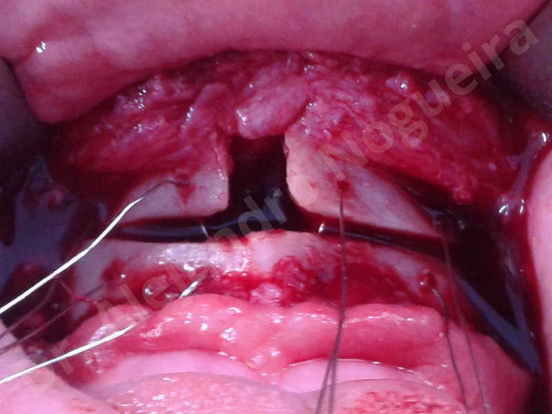 Large chin,Prominent chin,Horizontal osseous chin resection,Oblique chin osteotomy,Osseous chin setback,Three dimensional genioplasty,Vertical osseous chin resection - photo 23