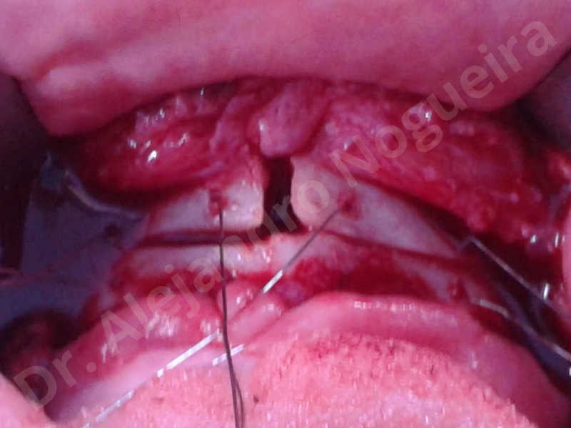 Large chin,Prominent chin,Horizontal osseous chin resection,Oblique chin osteotomy,Osseous chin setback,Three dimensional genioplasty,Vertical osseous chin resection - photo 25