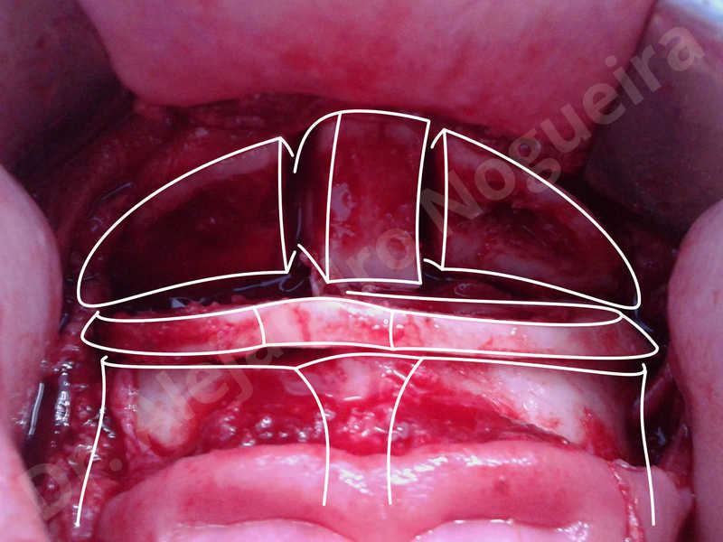 Large chin,Prominent chin,Horizontal osseous chin resection,Oblique chin osteotomy,Osseous chin setback,Three dimensional genioplasty,Vertical osseous chin resection - photo 6