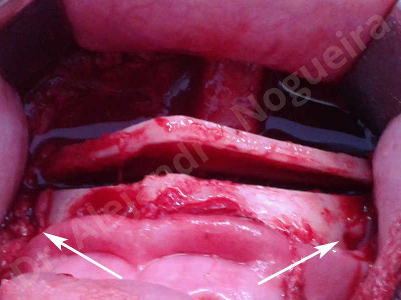 Large chin,Prominent chin,Horizontal osseous chin resection,Oblique chin osteotomy,Osseous chin setback,Three dimensional genioplasty,Vertical osseous chin resection - photo 9