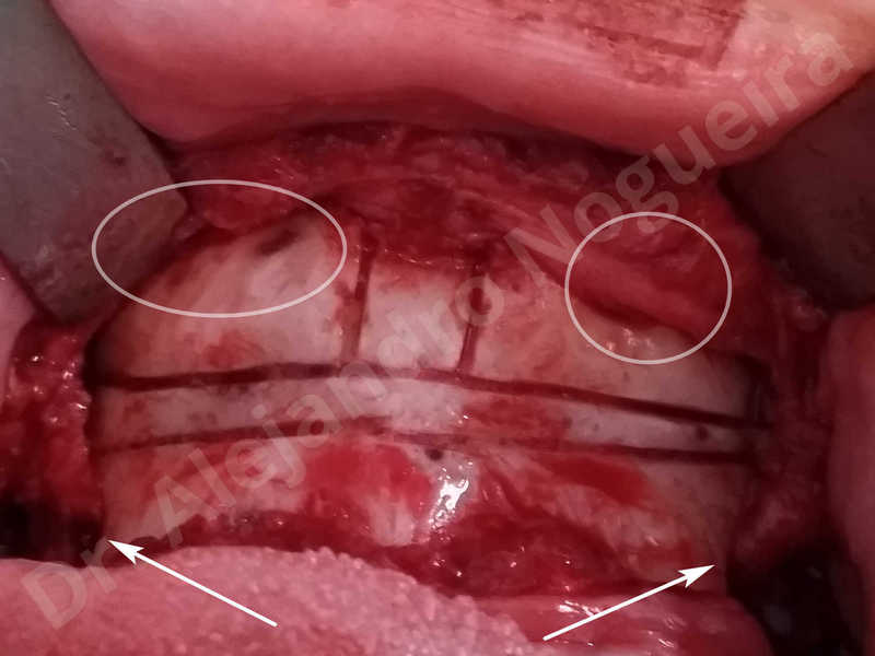 Large chin,Prominent chin,Transgender chin,Horizontal osseous chin resection,Oblique chin osteotomy,Osseous chin setback,Three dimensional genioplasty,Vertical osseous chin resection - photo 14