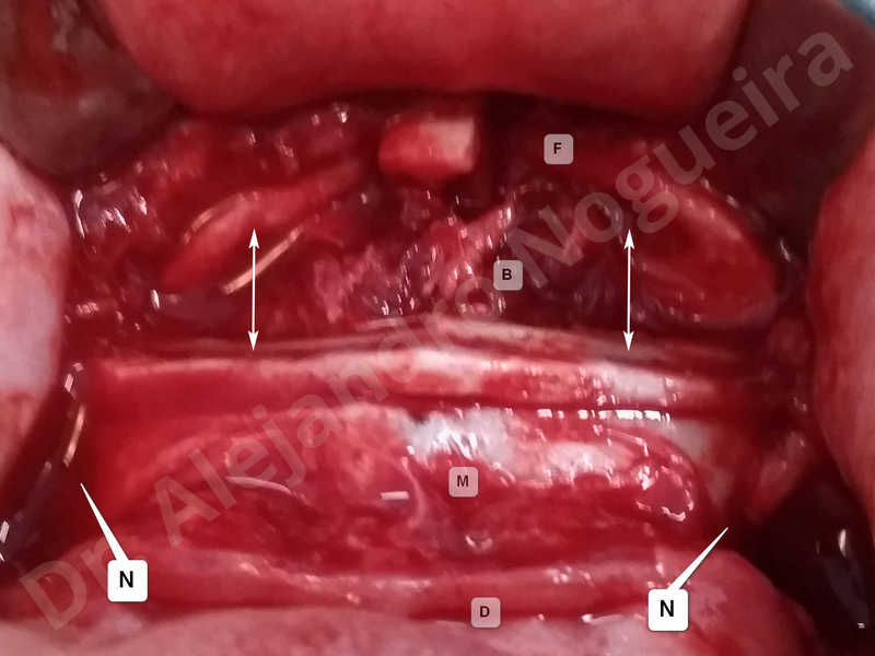 Large chin,Prominent chin,Transgender chin,Horizontal osseous chin resection,Oblique chin osteotomy,Osseous chin setback,Three dimensional genioplasty,Vertical osseous chin resection - photo 19