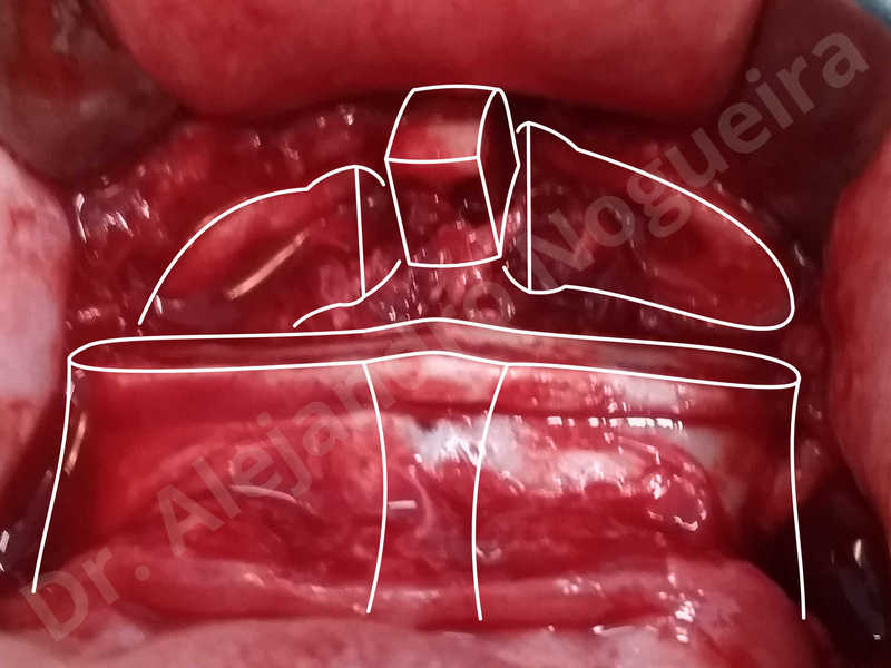 Large chin,Prominent chin,Transgender chin,Horizontal osseous chin resection,Oblique chin osteotomy,Osseous chin setback,Three dimensional genioplasty,Vertical osseous chin resection - photo 20