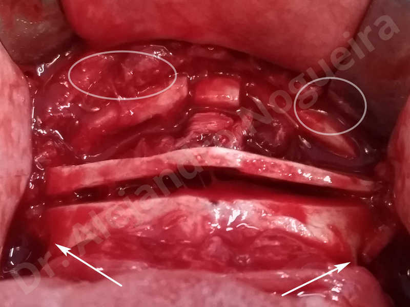 Large chin,Prominent chin,Transgender chin,Horizontal osseous chin resection,Oblique chin osteotomy,Osseous chin setback,Three dimensional genioplasty,Vertical osseous chin resection - photo 21