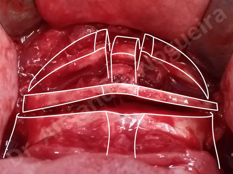 Large chin,Prominent chin,Transgender chin,Horizontal osseous chin resection,Oblique chin osteotomy,Osseous chin setback,Three dimensional genioplasty,Vertical osseous chin resection - photo 22