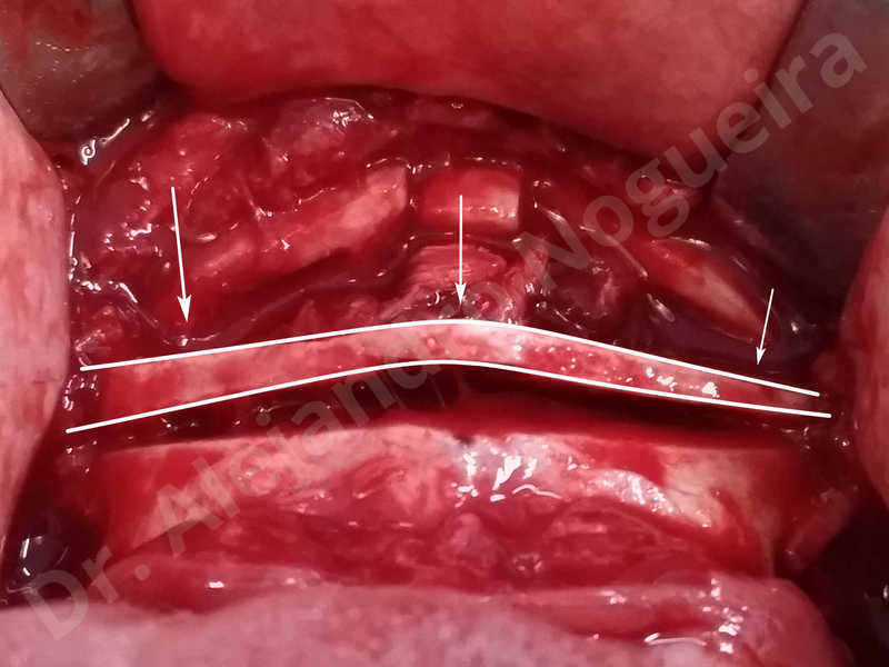 Large chin,Prominent chin,Transgender chin,Horizontal osseous chin resection,Oblique chin osteotomy,Osseous chin setback,Three dimensional genioplasty,Vertical osseous chin resection - photo 23