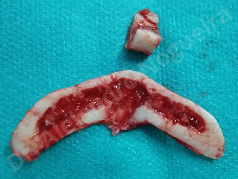 Large chin,Prominent chin,Transgender chin,Horizontal osseous chin resection,Oblique chin osteotomy,Osseous chin setback,Three dimensional genioplasty,Vertical osseous chin resection - photo 24