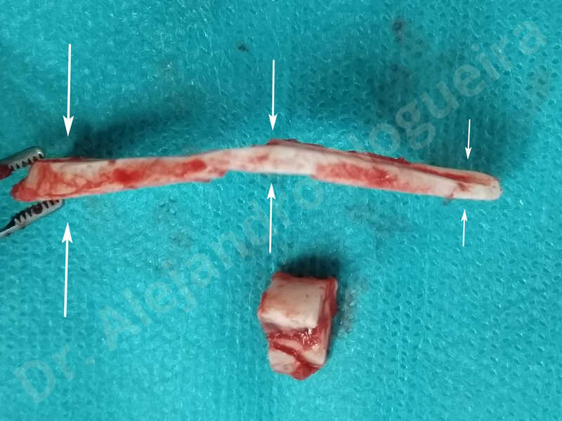 Large chin,Prominent chin,Transgender chin,Horizontal osseous chin resection,Oblique chin osteotomy,Osseous chin setback,Three dimensional genioplasty,Vertical osseous chin resection - photo 25