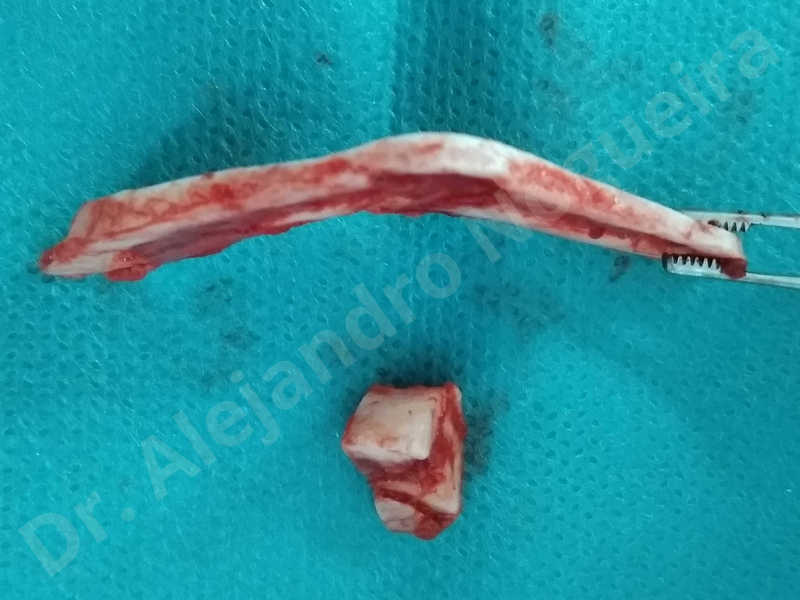 Large chin,Prominent chin,Transgender chin,Horizontal osseous chin resection,Oblique chin osteotomy,Osseous chin setback,Three dimensional genioplasty,Vertical osseous chin resection - photo 26