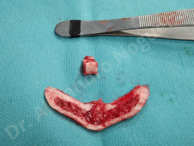 Large chin,Prominent chin,Transgender chin,Horizontal osseous chin resection,Oblique chin osteotomy,Osseous chin setback,Three dimensional genioplasty,Vertical osseous chin resection - photo 28