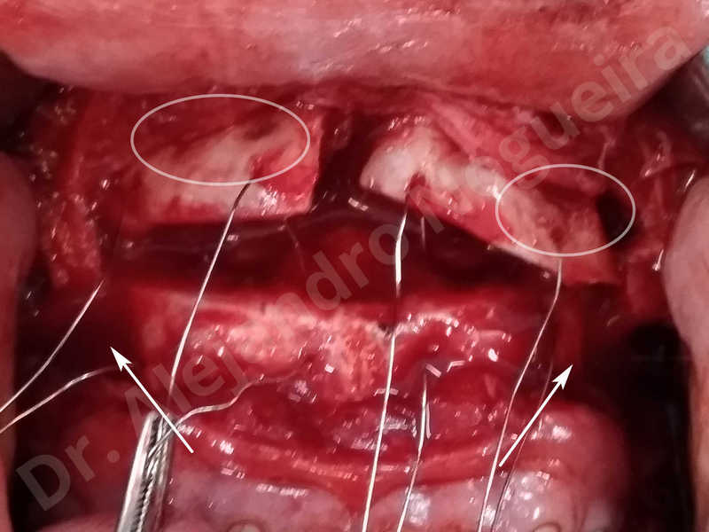 Large chin,Prominent chin,Transgender chin,Horizontal osseous chin resection,Oblique chin osteotomy,Osseous chin setback,Three dimensional genioplasty,Vertical osseous chin resection - photo 29