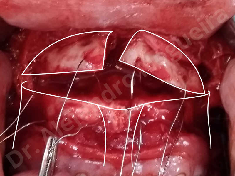 Large chin,Prominent chin,Transgender chin,Horizontal osseous chin resection,Oblique chin osteotomy,Osseous chin setback,Three dimensional genioplasty,Vertical osseous chin resection - photo 30