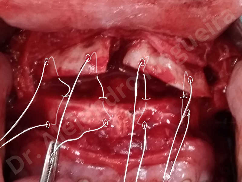 Large chin,Prominent chin,Transgender chin,Horizontal osseous chin resection,Oblique chin osteotomy,Osseous chin setback,Three dimensional genioplasty,Vertical osseous chin resection - photo 31