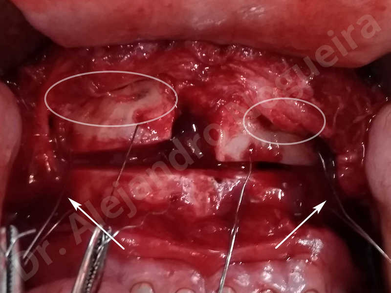 Large chin,Prominent chin,Transgender chin,Horizontal osseous chin resection,Oblique chin osteotomy,Osseous chin setback,Three dimensional genioplasty,Vertical osseous chin resection - photo 32