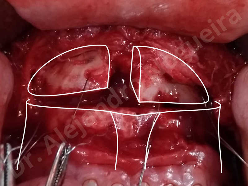 Large chin,Prominent chin,Transgender chin,Horizontal osseous chin resection,Oblique chin osteotomy,Osseous chin setback,Three dimensional genioplasty,Vertical osseous chin resection - photo 33