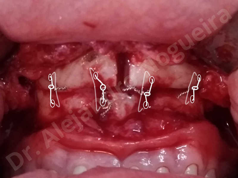 Large chin,Prominent chin,Transgender chin,Horizontal osseous chin resection,Oblique chin osteotomy,Osseous chin setback,Three dimensional genioplasty,Vertical osseous chin resection - photo 40