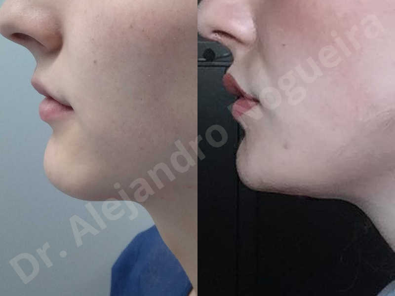Large chin,Prominent chin,Transgender chin,Horizontal osseous chin resection,Oblique chin osteotomy,Osseous chin setback,Three dimensional genioplasty,Vertical osseous chin resection - photo 42