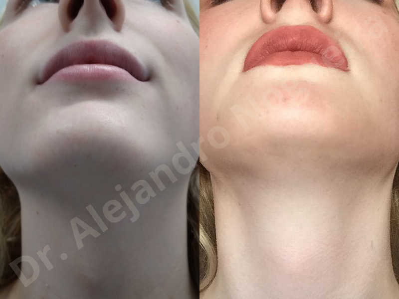 Large chin,Prominent chin,Transgender chin,Horizontal osseous chin resection,Oblique chin osteotomy,Osseous chin setback,Three dimensional genioplasty,Vertical osseous chin resection - photo 43