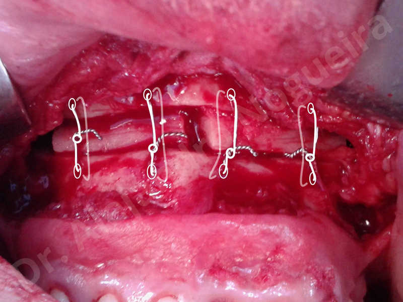 Small chin,Weak chin,Elbow bone graft harvesting,Oblique chin osteotomy,Osseous chin advancement,Two dimensional genioplasty,Vertical osseous chin grafting - photo 16