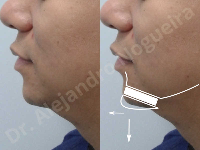 Small chin,Weak chin,Elbow bone graft harvesting,Oblique chin osteotomy,Osseous chin advancement,Two dimensional genioplasty,Vertical osseous chin grafting - photo 2