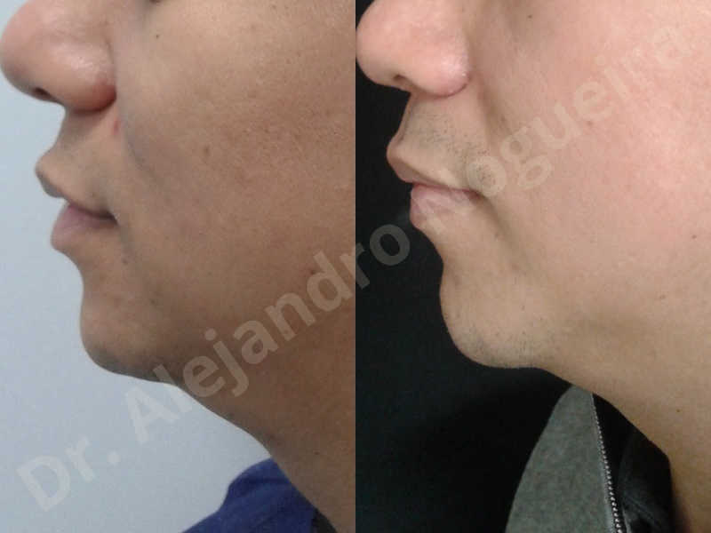 Small chin,Weak chin,Elbow bone graft harvesting,Oblique chin osteotomy,Osseous chin advancement,Two dimensional genioplasty,Vertical osseous chin grafting - photo 20