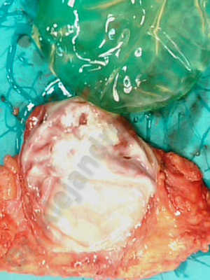 Breast implants capsular contracture,Breast implants capsule calcification,Breast implants displacement malposition,Breast implants riding too high,Breast tissue infection,Breast tissue necrosis,Broken breast implants,Lateral breasts,Mildly large breasts,Severely saggy droopy breasts,Too far apart wide cleavage breasts,Wide breasts,Capsulectomy
