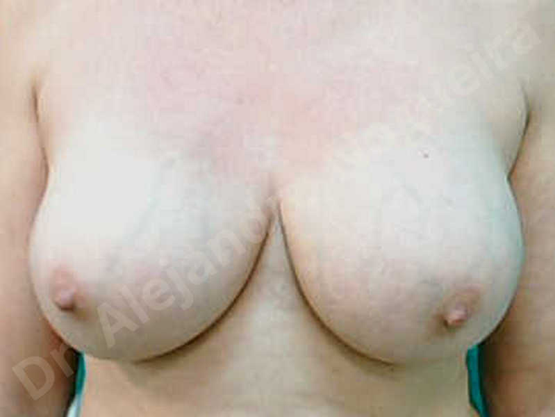 Breast implants capsular contracture,Breast implants capsule calcification,Breast implants displacement malposition,Breast implants riding too high,Breast tissue infection,Breast tissue necrosis,Broken breast implants,Lateral breasts,Mildly large breasts,Severely saggy droopy breasts,Too far apart wide cleavage breasts,Wide breasts,Capsulectomy - photo 1