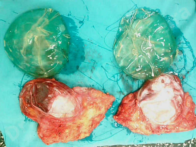 Breast implants capsular contracture,Breast implants capsule calcification,Breast implants displacement malposition,Breast implants riding too high,Breast tissue infection,Breast tissue necrosis,Broken breast implants,Lateral breasts,Mildly large breasts,Severely saggy droopy breasts,Too far apart wide cleavage breasts,Wide breasts,Capsulectomy - photo 8