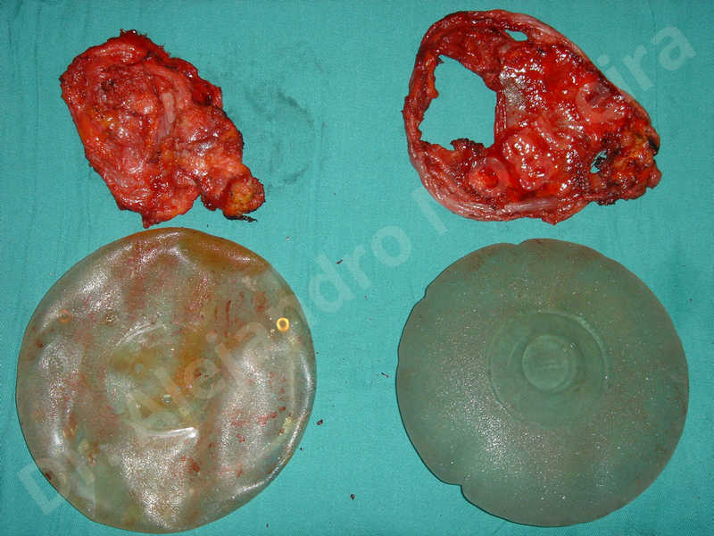 Asymmetric breasts,Broken breast implants,Empty breasts,Too narrow breast implants,Capsulectomy - photo 2