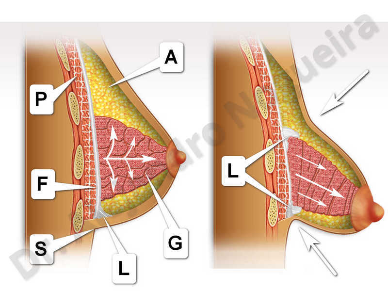 Large areolas,Tuberous breasts,Areola reduction,Tuberous mammoplasty - photo 1