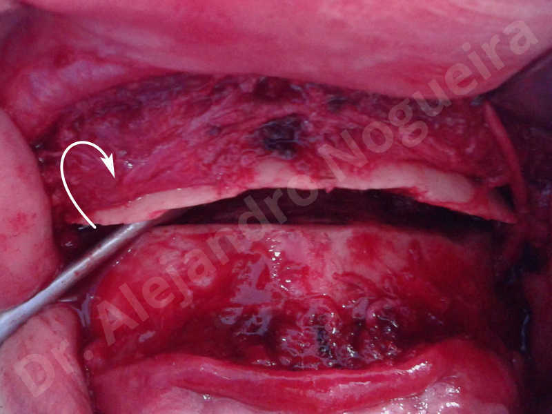 Small chin,Weak chin,Elbow bone graft harvesting,Oblique chin osteotomy,Osseous chin advancement,Two dimensional genioplasty,Vertical osseous chin grafting - photo 12