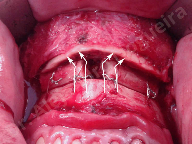 Small chin,Weak chin,Elbow bone graft harvesting,Oblique chin osteotomy,Osseous chin advancement,Two dimensional genioplasty,Vertical osseous chin grafting - photo 25