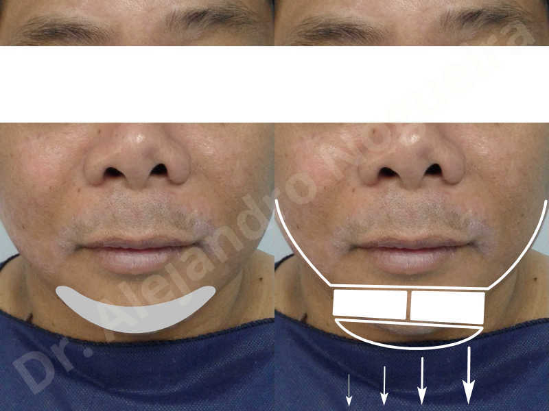 Hypertrophic scars,Small chin,Weak chin,Hip bone graft harvesting,Oblique chin osteotomy,Osseous chin advancement,Two dimensional genioplasty,Vertical osseous chin grafting - photo 1