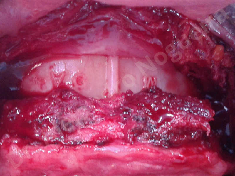 Hypertrophic scars,Small chin,Weak chin,Hip bone graft harvesting,Oblique chin osteotomy,Osseous chin advancement,Two dimensional genioplasty,Vertical osseous chin grafting - photo 10
