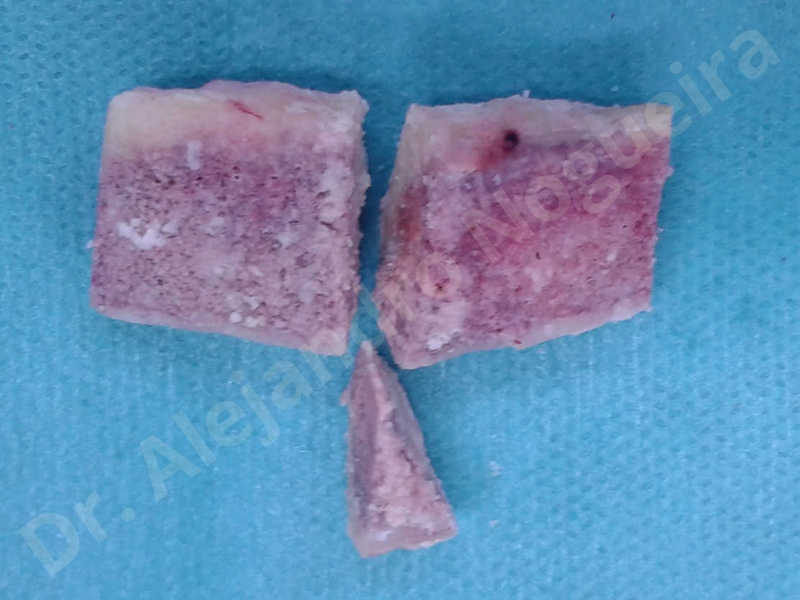 Hypertrophic scars,Small chin,Weak chin,Hip bone graft harvesting,Oblique chin osteotomy,Osseous chin advancement,Two dimensional genioplasty,Vertical osseous chin grafting - photo 14