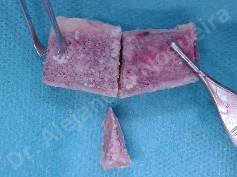 Hypertrophic scars,Small chin,Weak chin,Hip bone graft harvesting,Oblique chin osteotomy,Osseous chin advancement,Two dimensional genioplasty,Vertical osseous chin grafting - photo 15