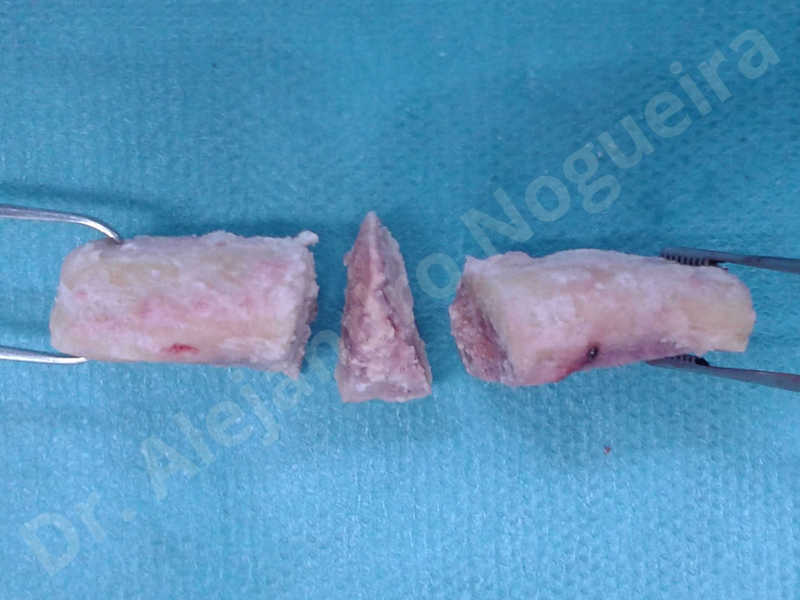Hypertrophic scars,Small chin,Weak chin,Hip bone graft harvesting,Oblique chin osteotomy,Osseous chin advancement,Two dimensional genioplasty,Vertical osseous chin grafting - photo 16