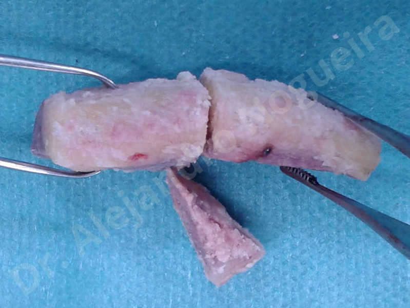 Hypertrophic scars,Small chin,Weak chin,Hip bone graft harvesting,Oblique chin osteotomy,Osseous chin advancement,Two dimensional genioplasty,Vertical osseous chin grafting - photo 18