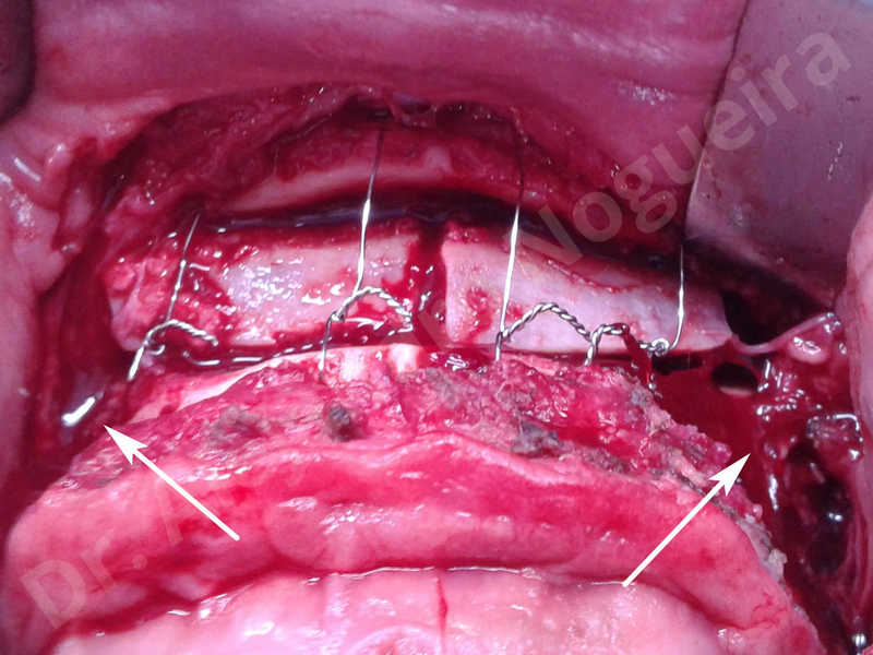 Hypertrophic scars,Small chin,Weak chin,Hip bone graft harvesting,Oblique chin osteotomy,Osseous chin advancement,Two dimensional genioplasty,Vertical osseous chin grafting - photo 19