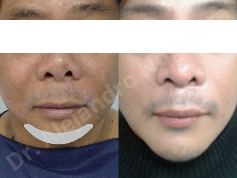 Hypertrophic scars,Small chin,Weak chin,Hip bone graft harvesting,Oblique chin osteotomy,Osseous chin advancement,Two dimensional genioplasty,Vertical osseous chin grafting - photo 23