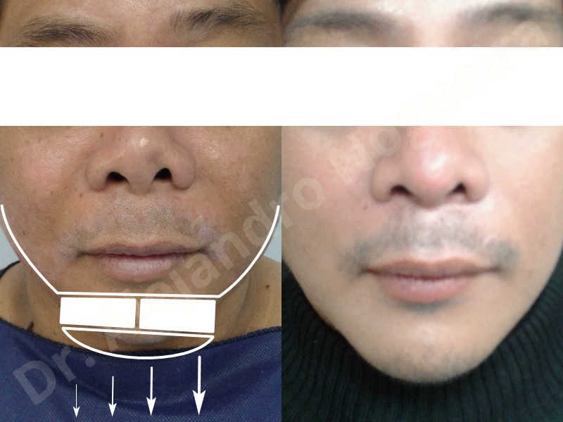 Hypertrophic scars,Small chin,Weak chin,Hip bone graft harvesting,Oblique chin osteotomy,Osseous chin advancement,Two dimensional genioplasty,Vertical osseous chin grafting - photo 25