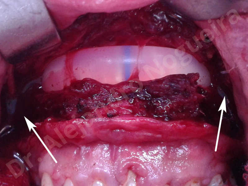Hypertrophic scars,Small chin,Weak chin,Hip bone graft harvesting,Oblique chin osteotomy,Osseous chin advancement,Two dimensional genioplasty,Vertical osseous chin grafting - photo 6
