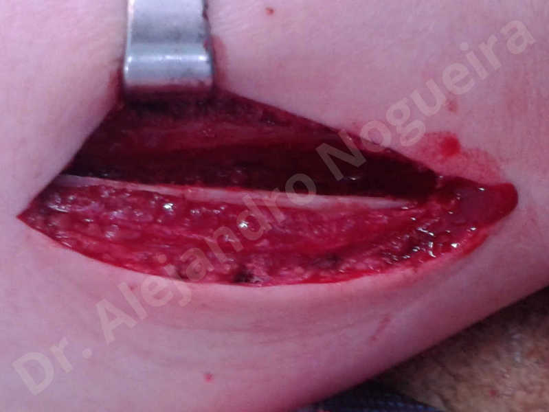 Small chin,Weak chin,Elbow bone graft harvesting,Oblique chin osteotomy,Osseous chin advancement,Two dimensional genioplasty,Vertical osseous chin grafting - photo 10
