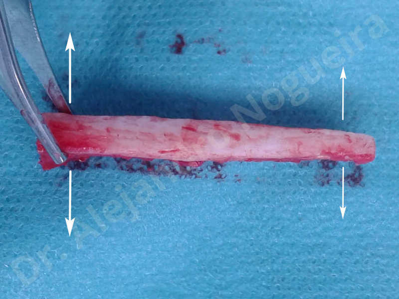 Small chin,Weak chin,Elbow bone graft harvesting,Oblique chin osteotomy,Osseous chin advancement,Two dimensional genioplasty,Vertical osseous chin grafting - photo 12