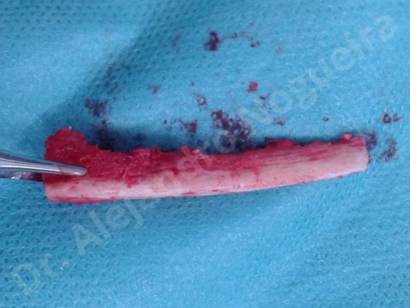 Small chin,Weak chin,Elbow bone graft harvesting,Oblique chin osteotomy,Osseous chin advancement,Two dimensional genioplasty,Vertical osseous chin grafting - photo 13