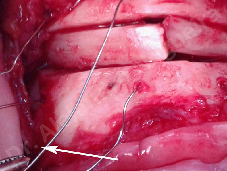 Small chin,Weak chin,Elbow bone graft harvesting,Oblique chin osteotomy,Osseous chin advancement,Two dimensional genioplasty,Vertical osseous chin grafting - photo 19