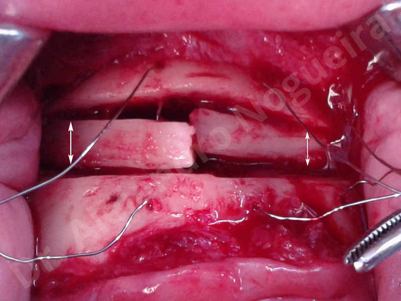 Small chin,Weak chin,Elbow bone graft harvesting,Oblique chin osteotomy,Osseous chin advancement,Two dimensional genioplasty,Vertical osseous chin grafting - photo 21