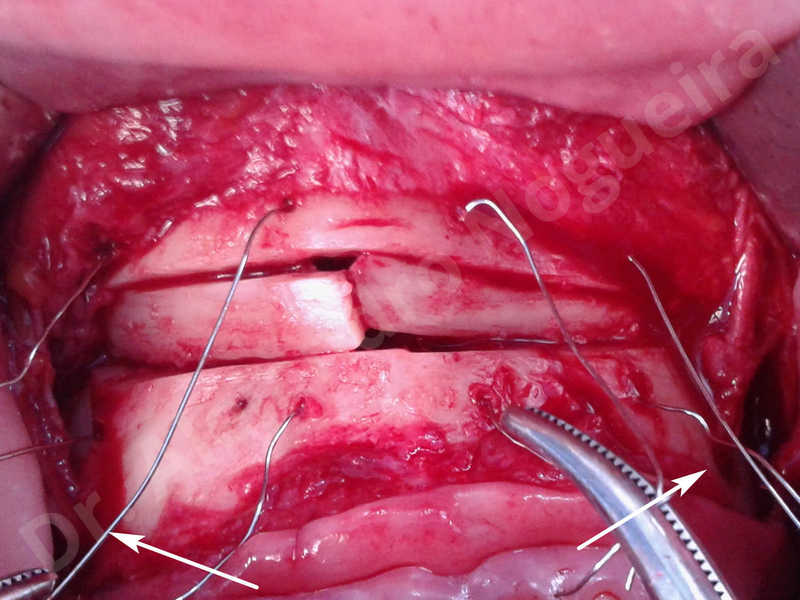 Small chin,Weak chin,Elbow bone graft harvesting,Oblique chin osteotomy,Osseous chin advancement,Two dimensional genioplasty,Vertical osseous chin grafting - photo 22