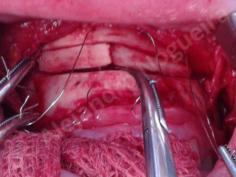 Small chin,Weak chin,Elbow bone graft harvesting,Oblique chin osteotomy,Osseous chin advancement,Two dimensional genioplasty,Vertical osseous chin grafting - photo 23