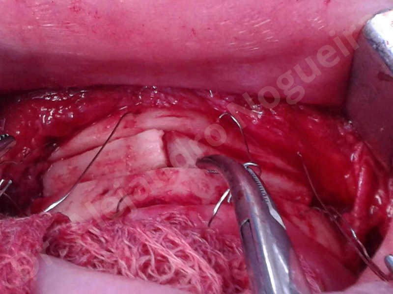 Small chin,Weak chin,Elbow bone graft harvesting,Oblique chin osteotomy,Osseous chin advancement,Two dimensional genioplasty,Vertical osseous chin grafting - photo 24